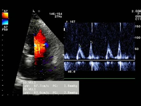 A Patient With Hypertension. The ECG, Echocardiogram and Left Ventricular Diastolic Function