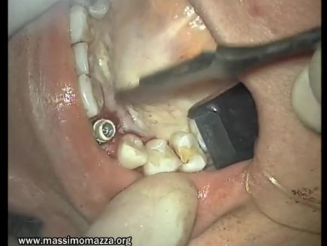 Regeneration Of Single Alveolar Process (2/3)