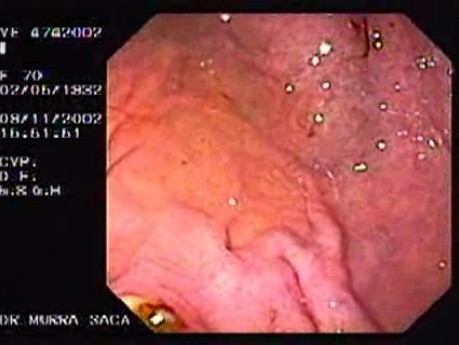 Dieulafoy´s Lesion (Exulceratio Simplex) (2 of 11)