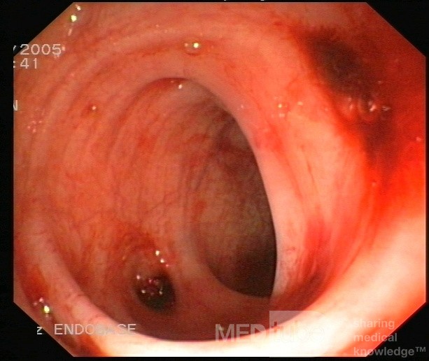 Bleeding From Sigmoid Diverticula