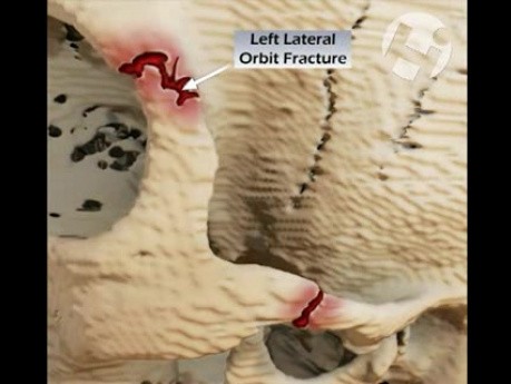 Volumated Skull Fractures