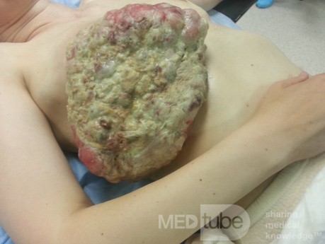 Chemoresistant Triple Negative Breast Cancer