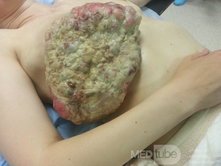 Chemoresistant Triple Negative Breast Cancer