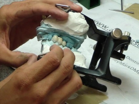Final Lab Processed Bridge Fabrication - Radica - Awesome Esthetics, Honestly