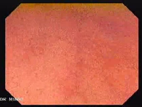 Magnifying Colonoscopy (2 of 2)
