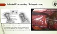 Difficult Cholecystectomy