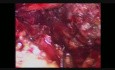 Laparoscopic Transhiatal Esophagectomy