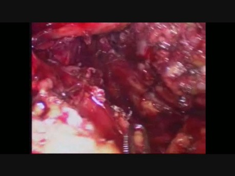Laparoscopic Transhiatal Esophagectomy