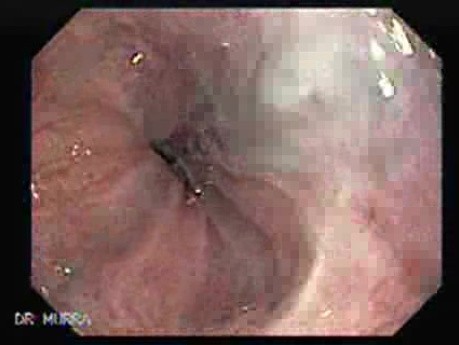 Ligation of Esophageal Varices - 33 Years-Old Male