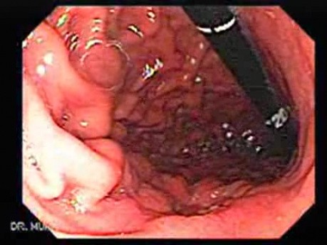 Adenocarcinoma of the Lesser Curvature with Signet Ring Cells (5 of 8)