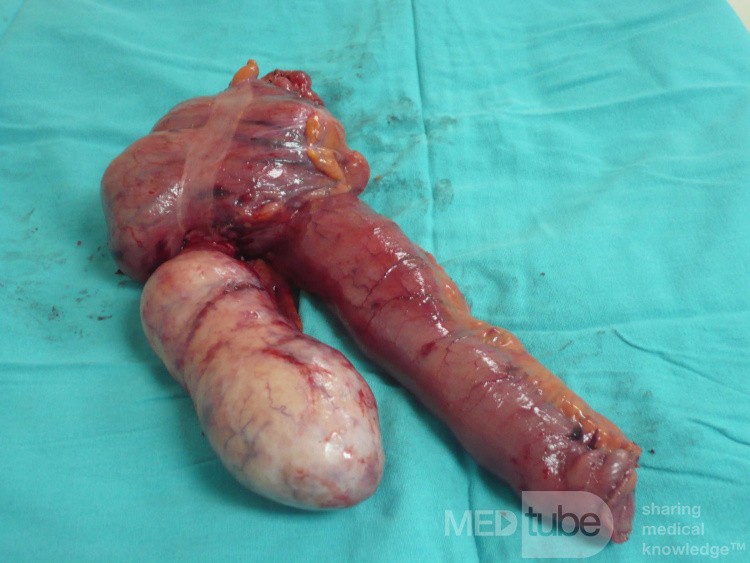 Appendiceal Carcinoid tumor (1 of 3)