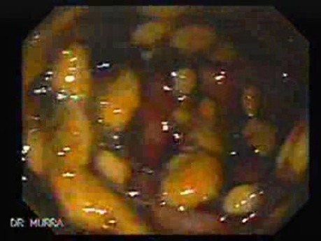 Pseudomembranous Colitis (2 of 11)