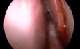 Septoplasty by Using The Septal Stapler (HD Quality)