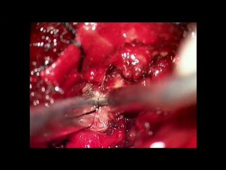 Paravertebral Tumor of the Thoracic Spine