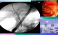 Modern Approach to a Complex Gallstone Problem