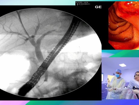 Modern Approach to a Complex Gallstone Problem