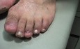 Stage-4 Ingrown Toenail—6 Months Later