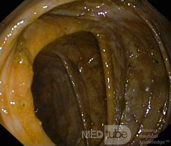 Endoscopic appearance of the Pseudomembranous colitis