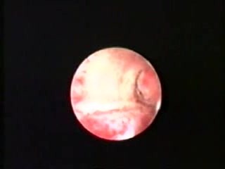 Hysteroscopic Treatment Of Osteoid Metaplasia