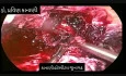 Scar Ectopic Preganancy