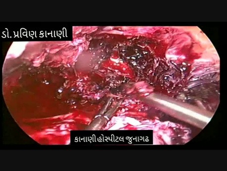 Scar Ectopic Preganancy