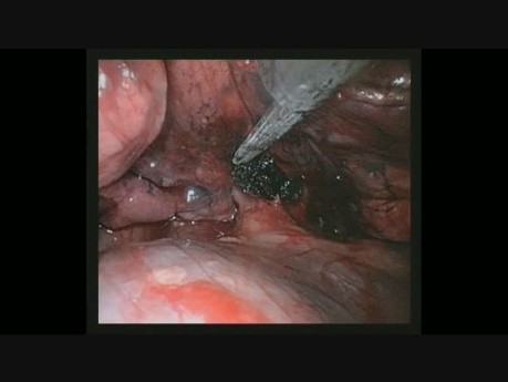 Bleeding Control by Uniportal VATS Right Upper Lobectomy