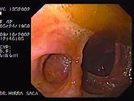 Ileum-transverse Anastomosis (1 of 3)