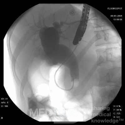 Adenocarcinoma of the head of the Pancreas that infiltrates
 the wall of duodenum (9 of 10)