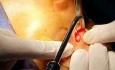 Osteoma in Nasoethmoida Area (2)