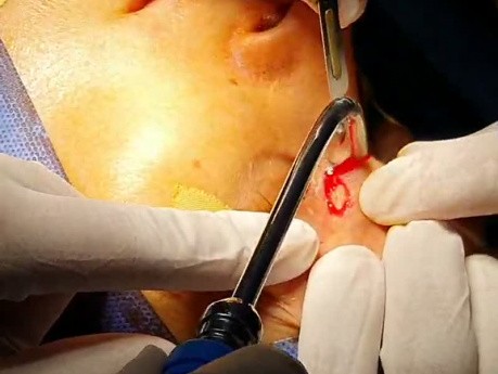 Osteoma in Nasoethmoida Area (2)