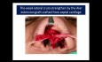 Practical Tips for Rhinoplasty in Thick Skin Patients 