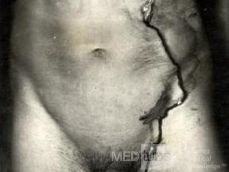Arrow Injury Of The Abdomen