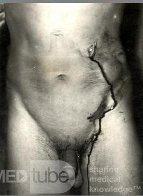 Arrow Injury Of The Abdomen