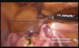 Laparoscopic Treatment of Retroverted Uterus 
