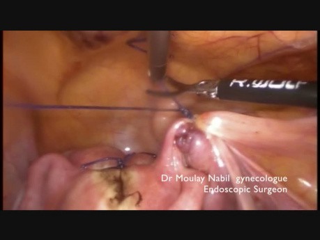 Laparoscopic Treatment of Retroverted Uterus 