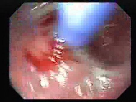 Balloon Dilatation for Achalasia - Prefered Way of Treatment