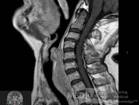 Esophageal Squamous Cell Carcinoma of the the upper third of the Esophagus that invades the subglotic (5 of 8)