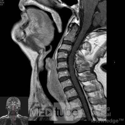 Esophageal Squamous Cell Carcinoma of the the upper third of the Esophagus that invades the subglotic (5 of 8)