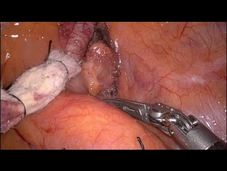 Removal of a Superior Mediastinal Nodal Tumour Mass