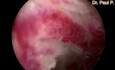 Hysteroscopic Excision of Endometrium