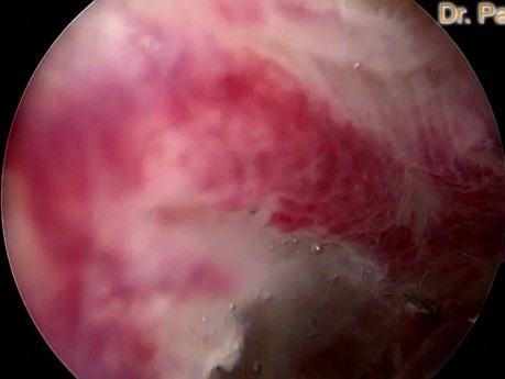 Hysteroscopic Excision of Endometrium