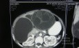 Right and left liver hydatid cyst - Abdominal CT