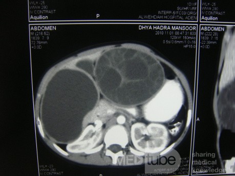 Right and left liver hydatid cyst - Abdominal CT
