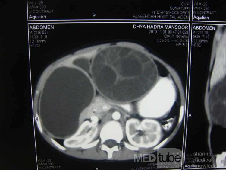 Right and left liver hydatid cyst - Abdominal CT