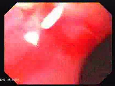Adenocarcinoma of the Cardia (4 of 4)