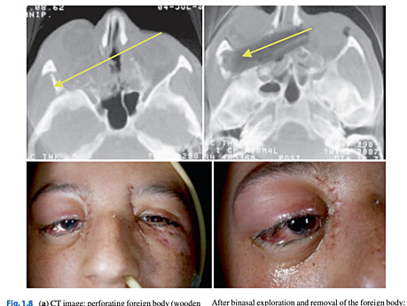 Craniofacial Trauma