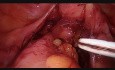 Laparoscopic Low Anterior Rectal Resection with Intra-Operative Leakage Repair