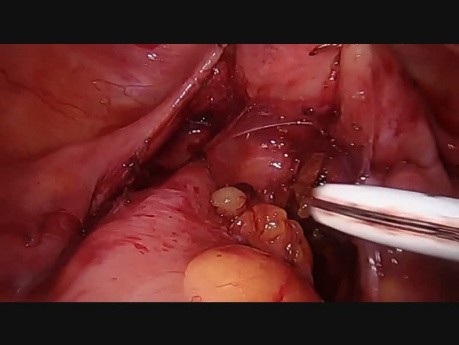 Laparoscopic Low Anterior Rectal Resection with Intra-Operative Leakage Repair