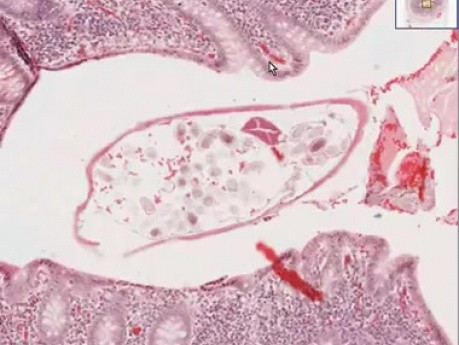 Pinworms