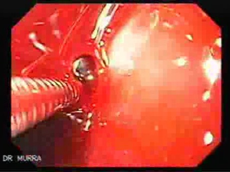 Severe Bleeding after Biopsies (6 of 7)